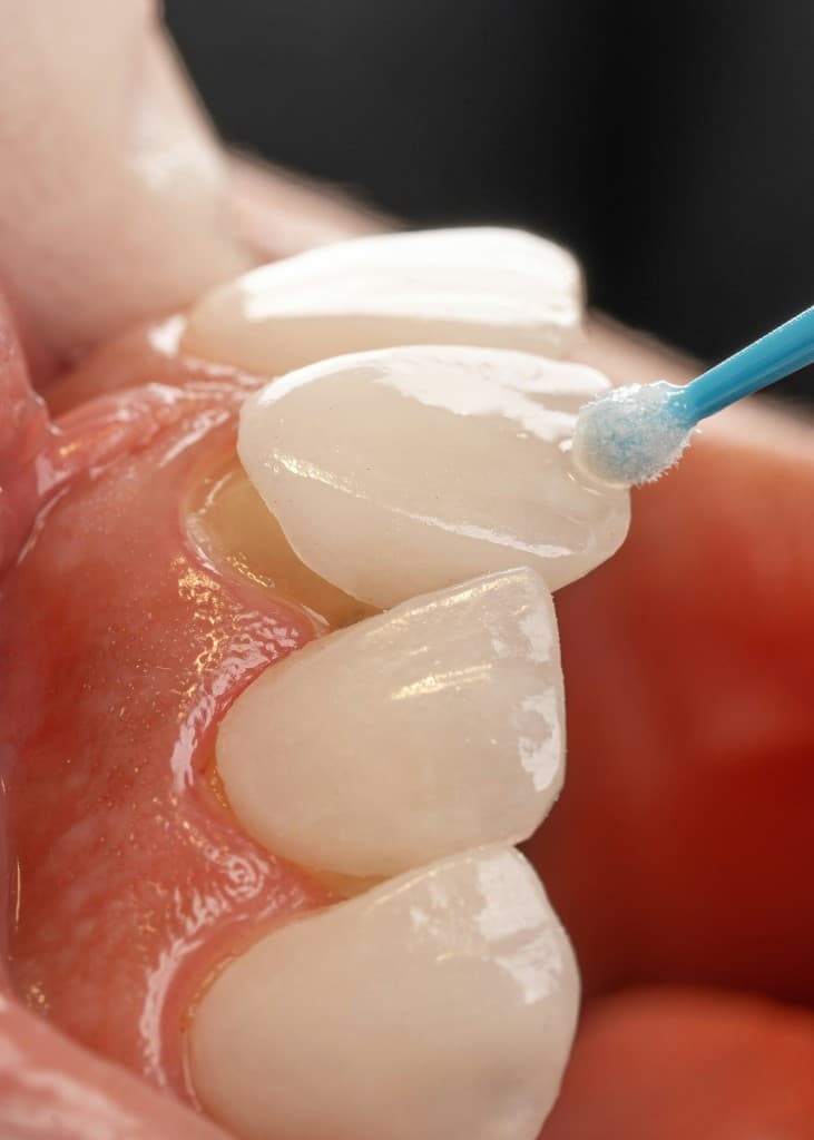 Cosmetic veneer treatment at Smile Bright Dental