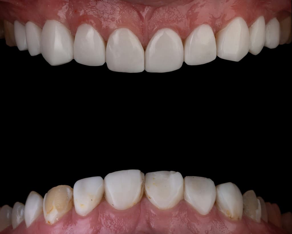 Teeth Whitening at Smile Bright Dental Westlands
